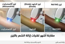 إزالة الشعر بالليزر
