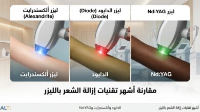 إزالة الشعر بالليزر
